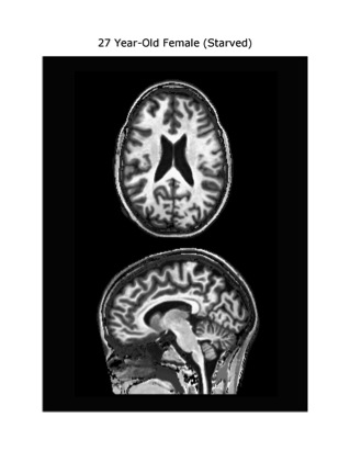 MRI of 27 Year-Old Female-Starved brain